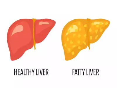 How to reverse fatty liver disease? Know here