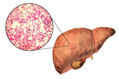 World Liver Day 2023: Fatty liver in kids; tips for prevention