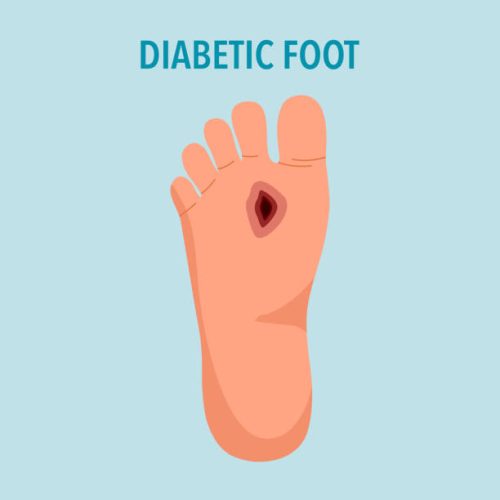 Introducing a groundbreaking Indian gel designed to accelerate the healing process of diabetic foot ulcers.