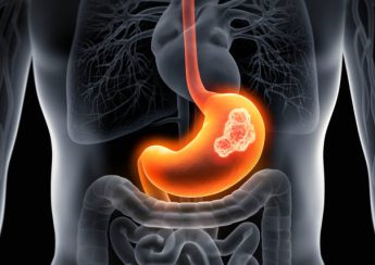 Gastric Cancer Overview: Causes, Symptoms, Treatment, Prevention Tips, and Key Facts.