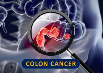 Colon Cancer in Young People: Symptoms and 5 Prevention Tips