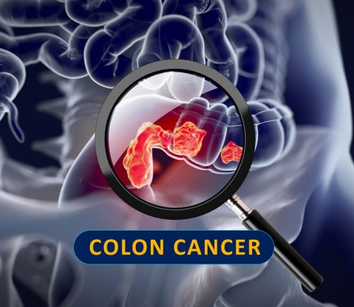 Colon Cancer in Young People: Symptoms and 5 Prevention Tips